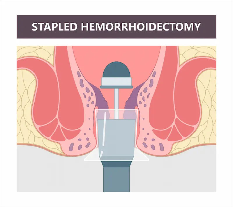 Laser Surgery for Piles Complete Guide for Faster Relief